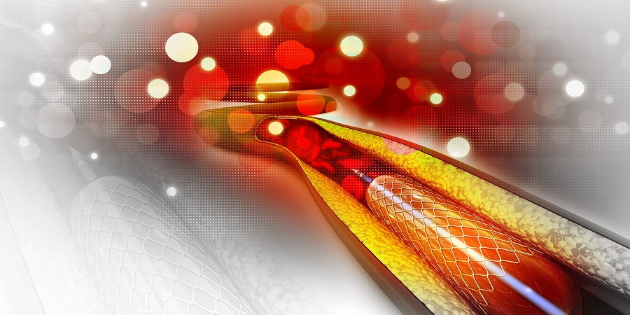 Stent beültetése