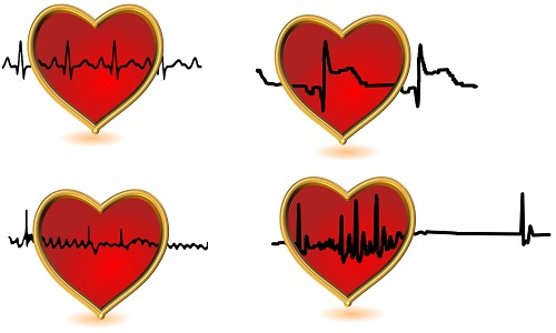 Egyes szívdobbanások előre vetíthetik a szívritmuszavart