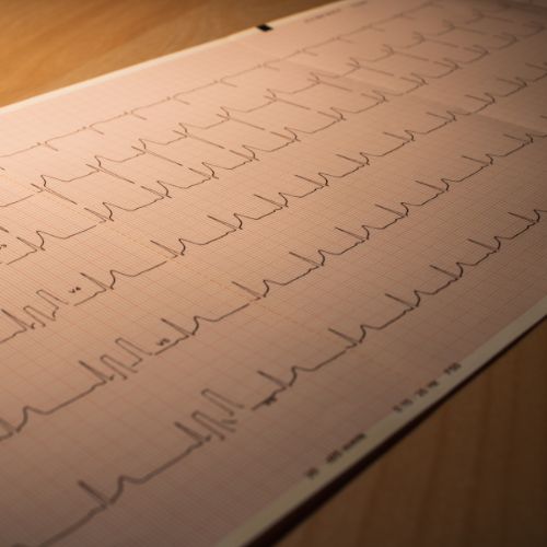 Mitől ugrálhat a pulzusa és mikor lehet szüksége Holter EKG-ra? - Kardioközpont