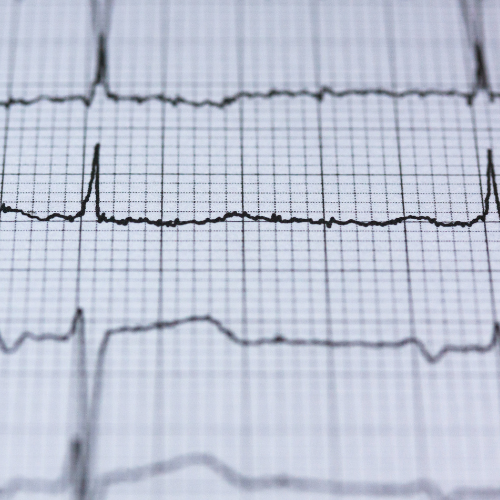 Terheléses EKG - Kardio Központ