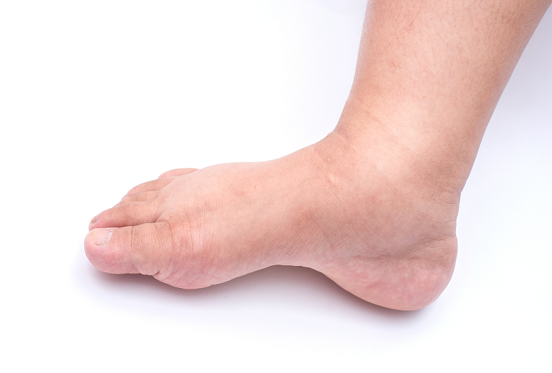 boka duzzanat és láb kezelés shiatsu a térd artrózisában